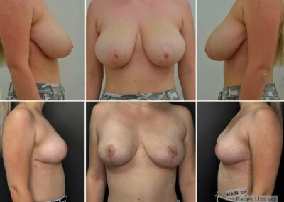 Brustverkleinerung - Vergleich der Situation vor und nach der Operation - Vorher- / Nachher, Dr. Radek Lhotsky